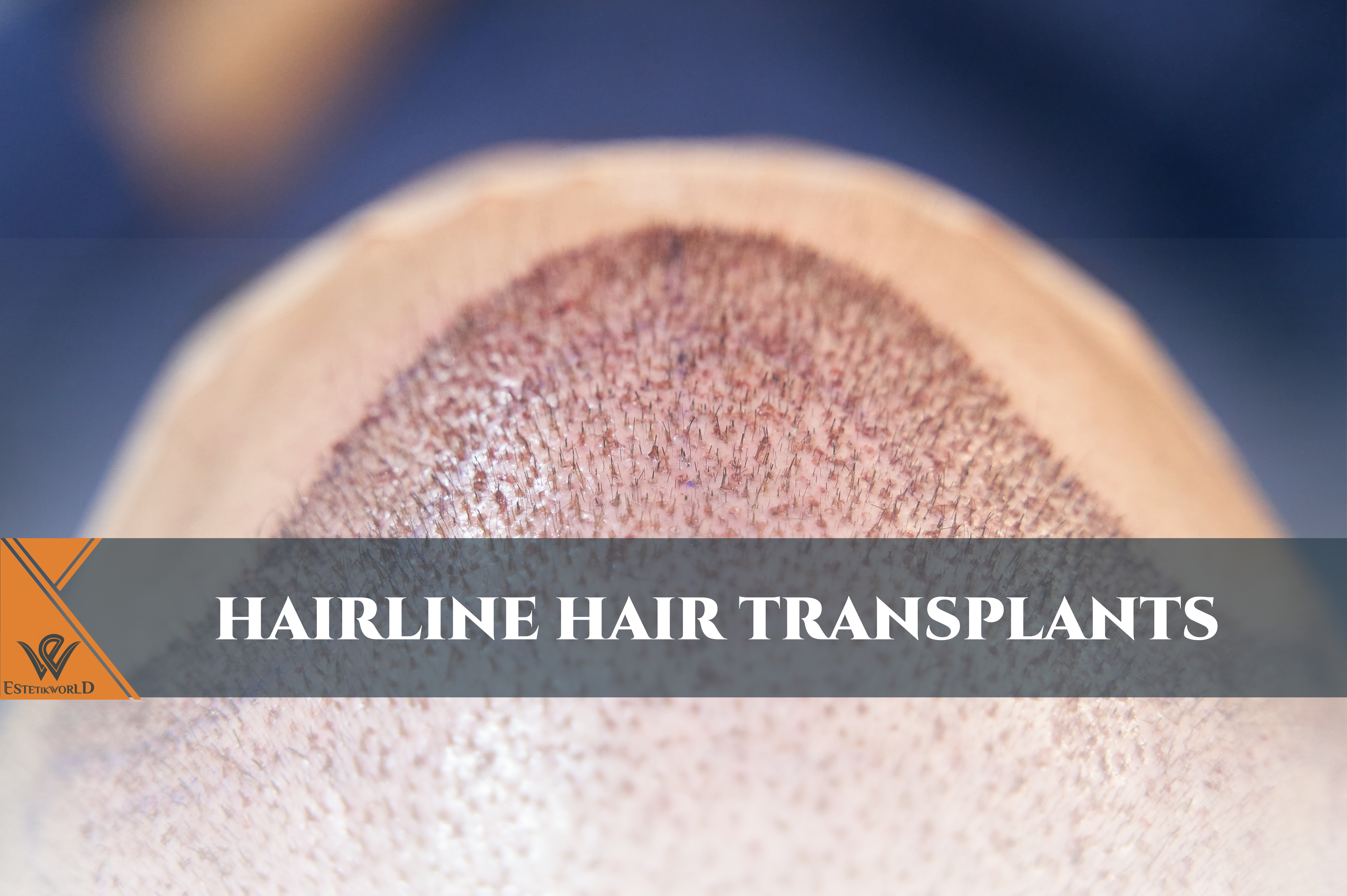 Hairline hair transplant